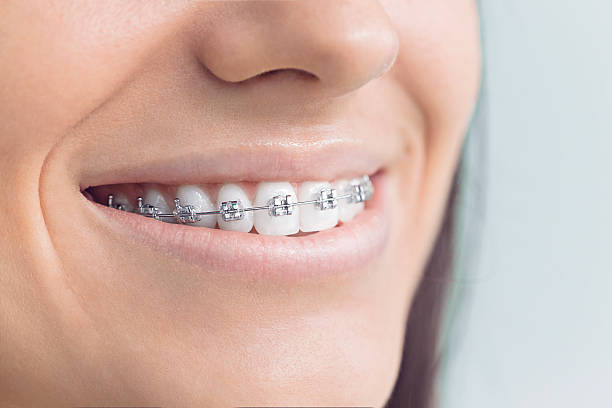 Dental Bonding in Goulding, FL